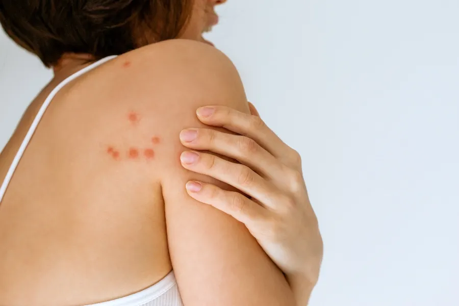 A person's shoulder showing a cluster of red, raised welts that are typical symptoms of bed bug bites.