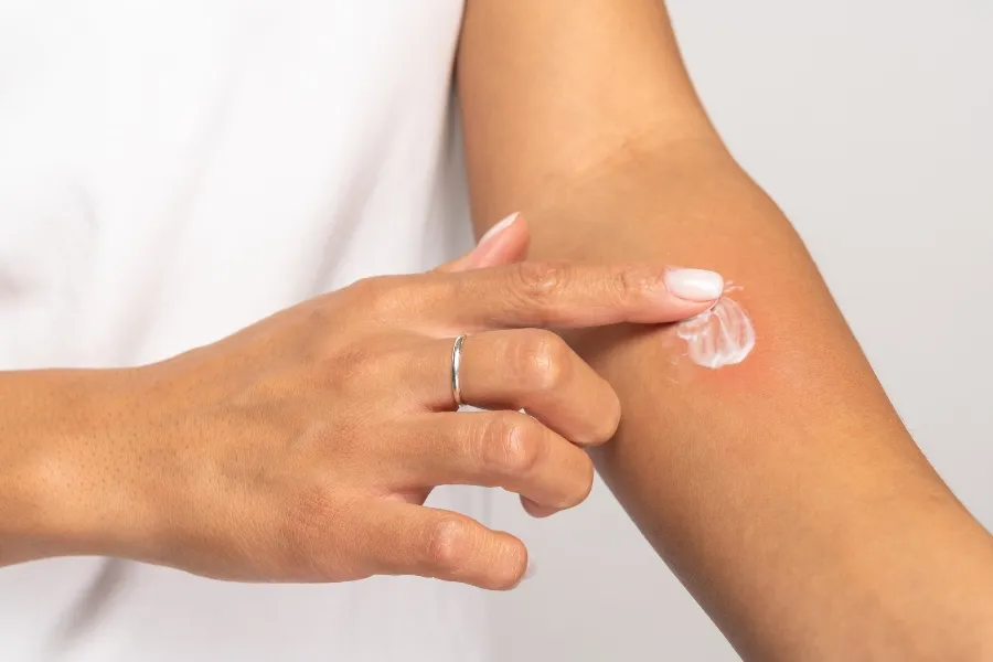 A person applying soothing white topical cream to a red welt on their forearm to treat itchy bed bug bites.