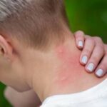 a person with many mosquito bites - why do some people get bit more than others?